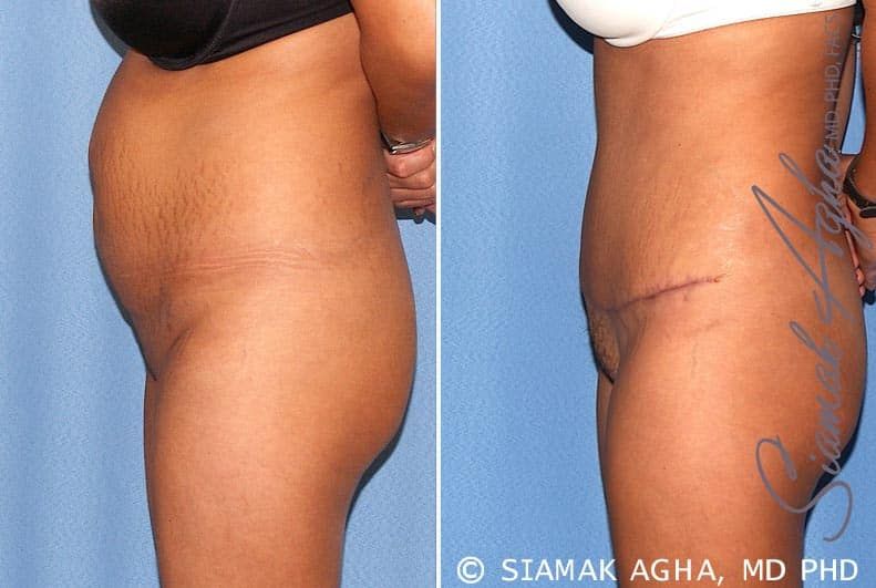 Tummy Tuck Before & After