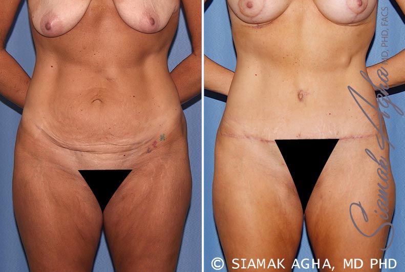 Tummy Tuck Before & After