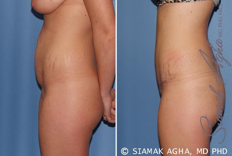 Tummy Tuck Before & After