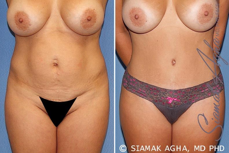 Tummy Tuck Before & After