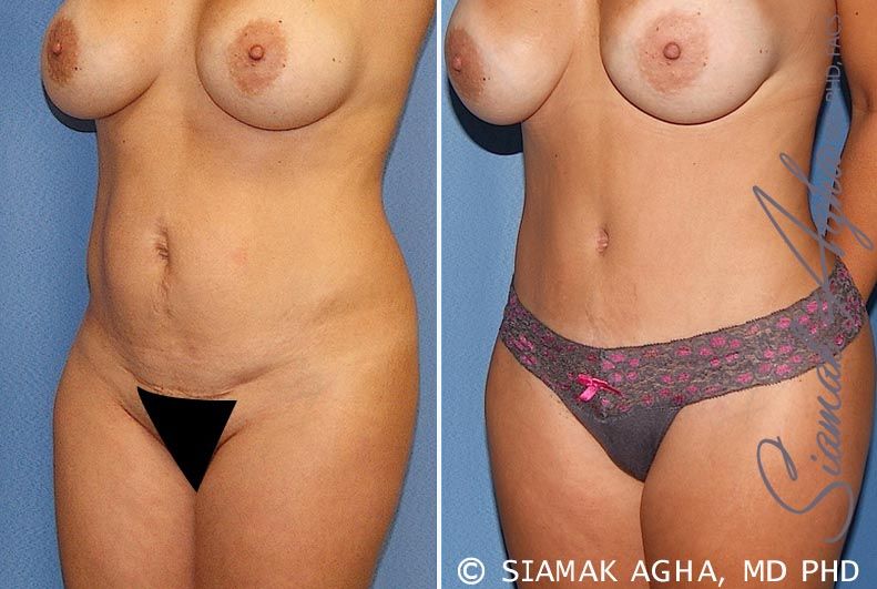 Tummy Tuck Before & After