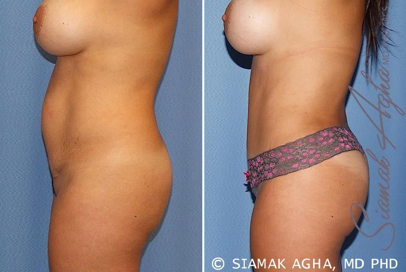 Tummy Tuck Before & After