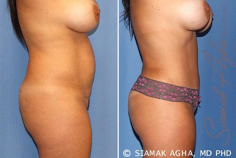 Tummy Tuck Before & After