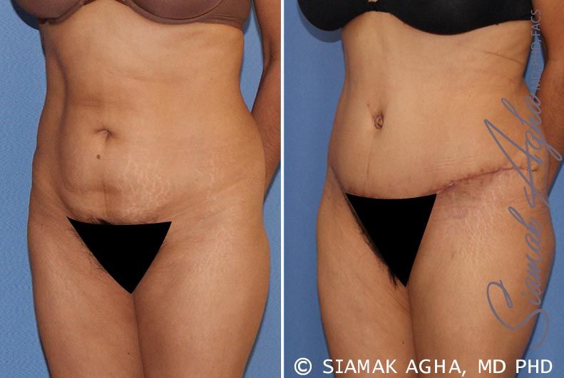 Tummy Tuck Before & After