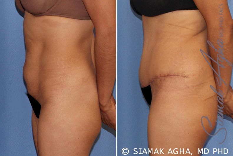 Tummy Tuck Before & After