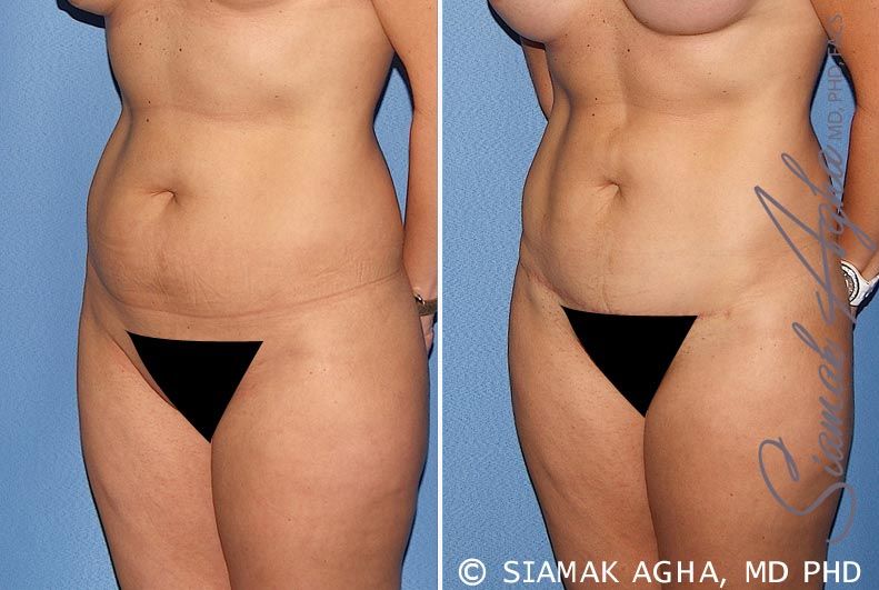 Tummy Tuck Before & After