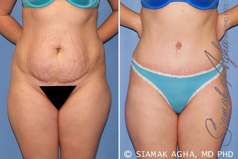 Tummy Tuck Before & After