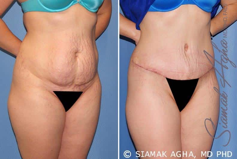 Tummy Tuck Before & After