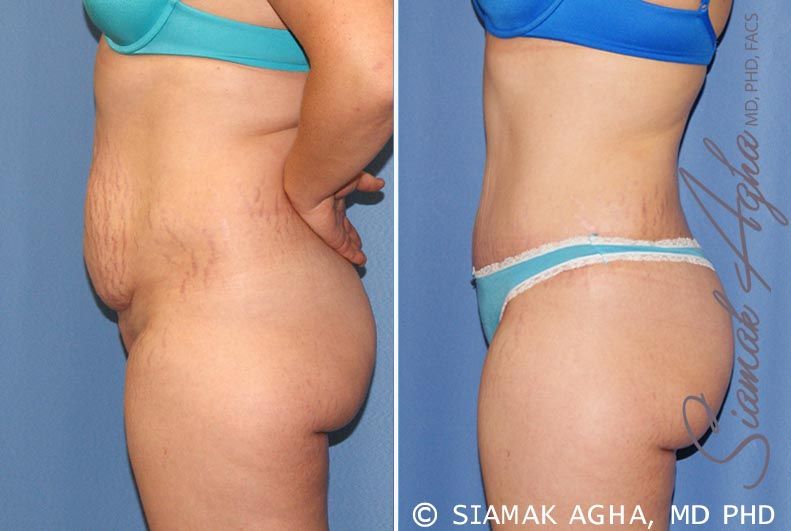 Tummy Tuck Before & After