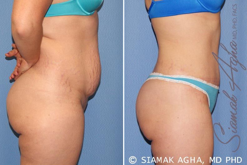 Tummy Tuck Before & After