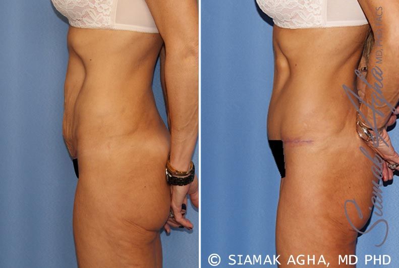 Tummy Tuck Before & After