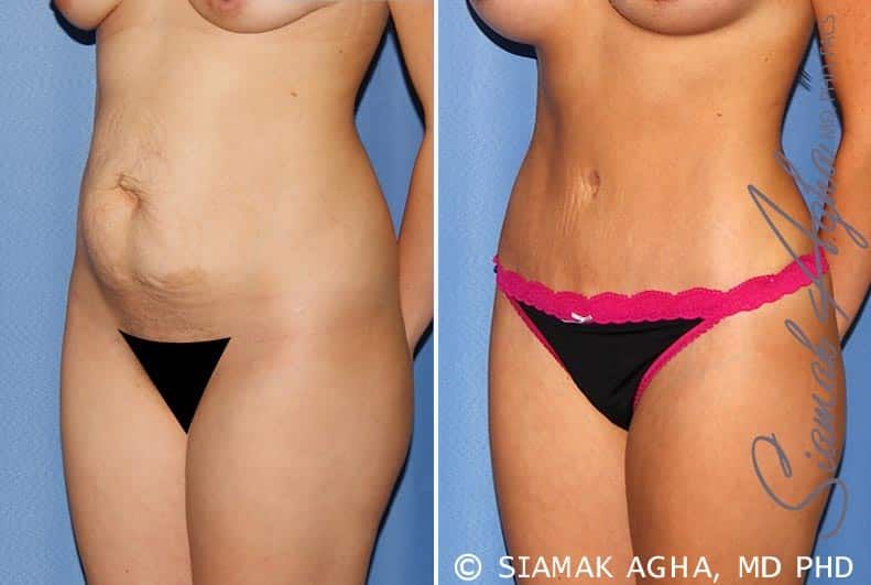 Tummy Tuck Before & After