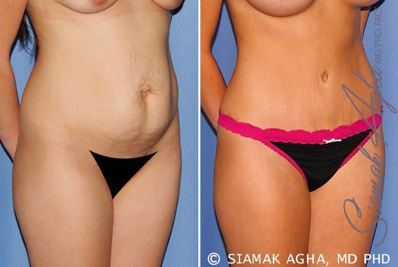 Tummy Tuck Before & After