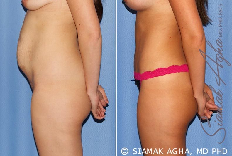 Tummy Tuck Before & After