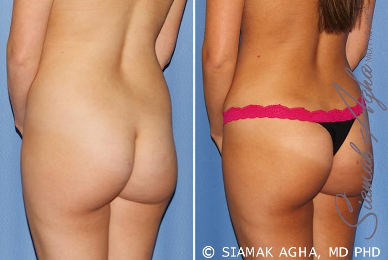 Tummy Tuck Before & After