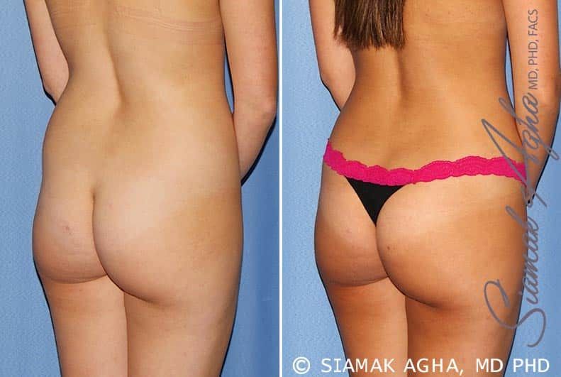 Tummy Tuck Before & After