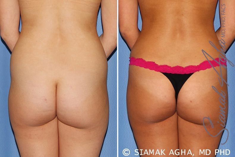 Tummy Tuck Before & After