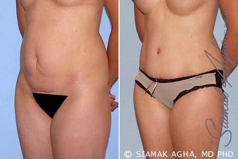 Tummy Tuck Before & After