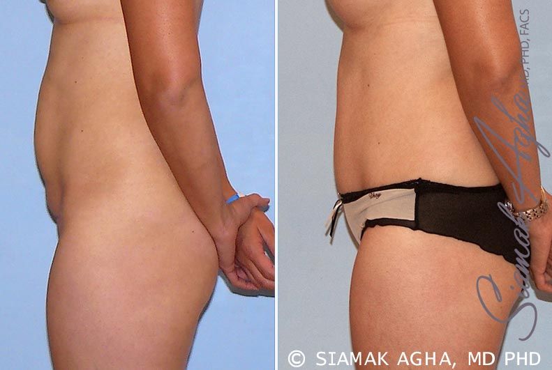 Tummy Tuck Before & After