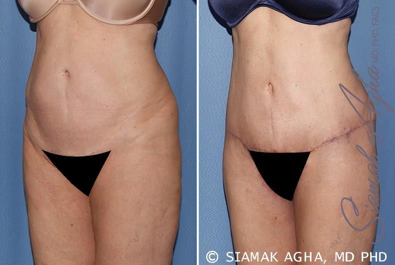 Tummy Tuck Before & After