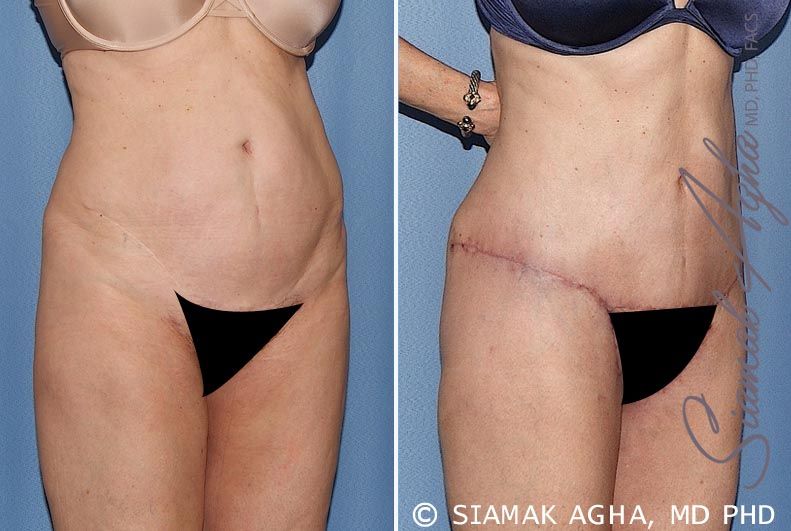 Tummy Tuck Before & After