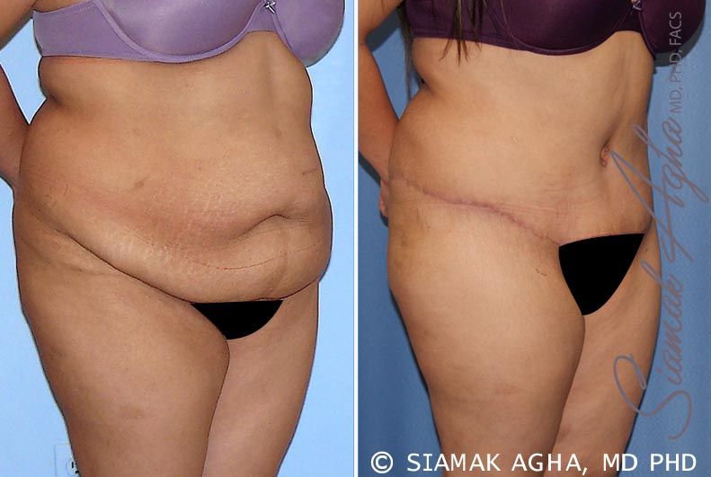 Tummy Tuck Before & After