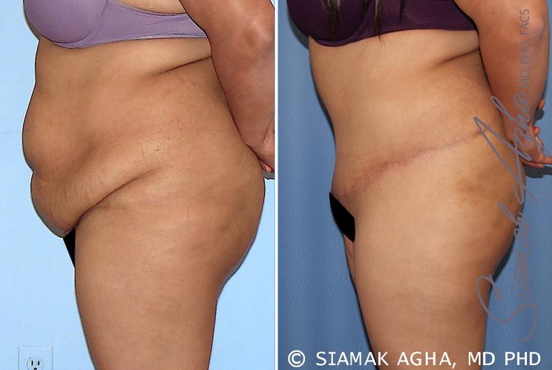 Tummy Tuck Before & After