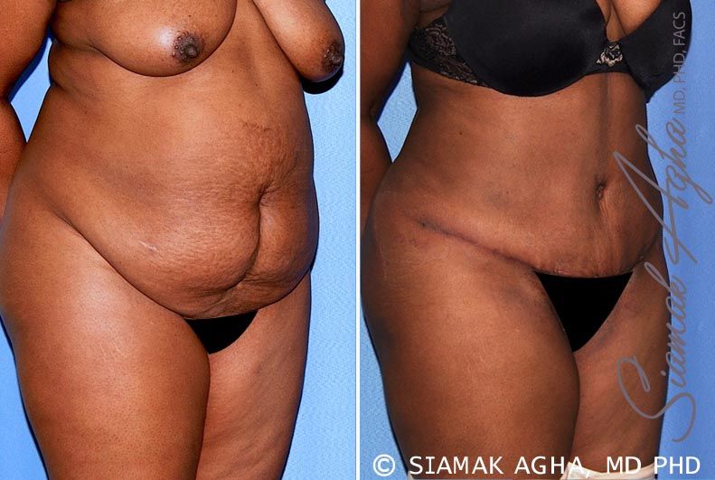 Tummy Tuck Before & After