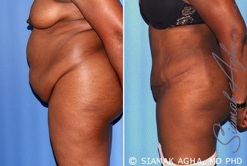 Tummy Tuck Before & After
