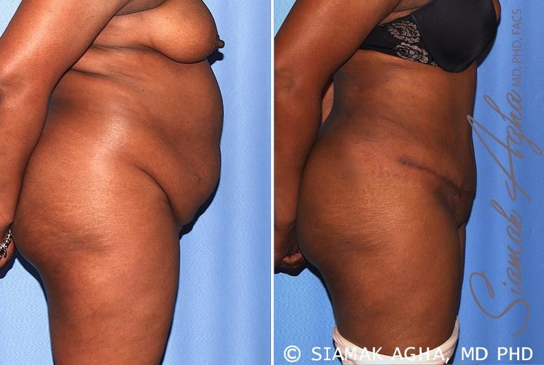 Tummy Tuck Before & After