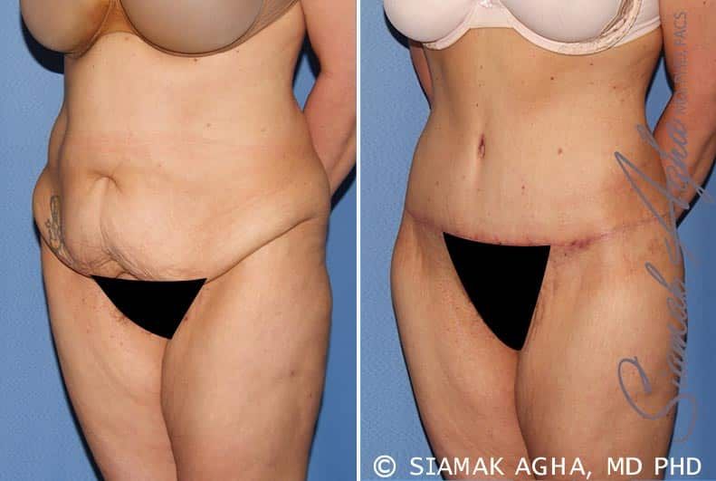 Tummy Tuck Before & After