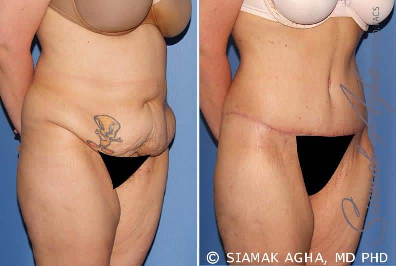 Tummy Tuck Before & After