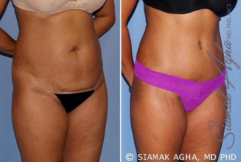 Tummy Tuck Before & After