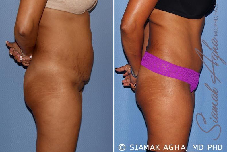 Tummy Tuck Before & After