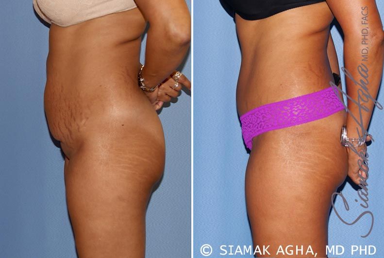 Tummy Tuck Before & After