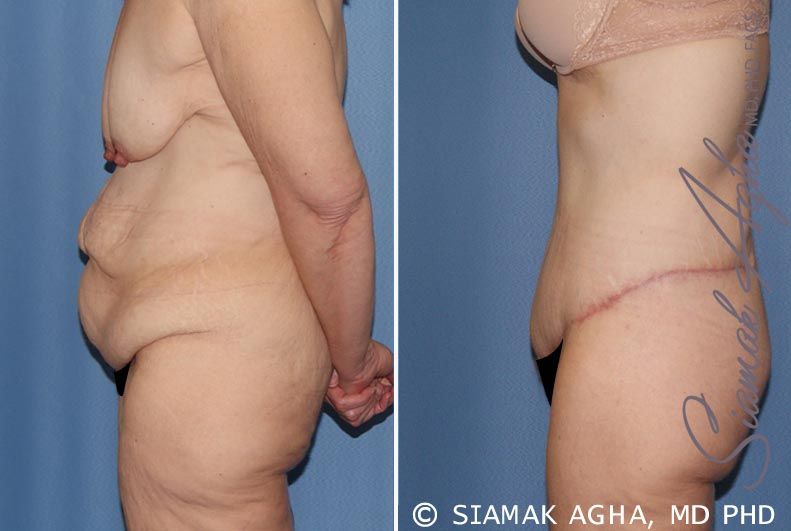 Tummy Tuck Before & After