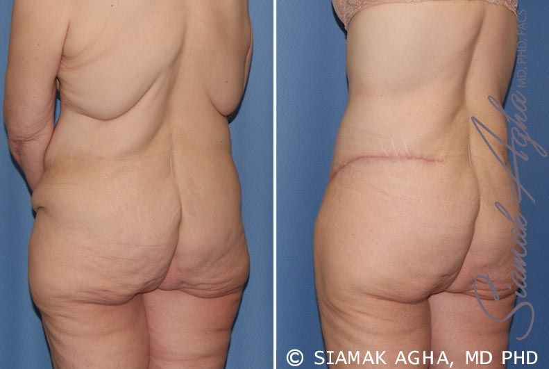 Tummy Tuck Before & After