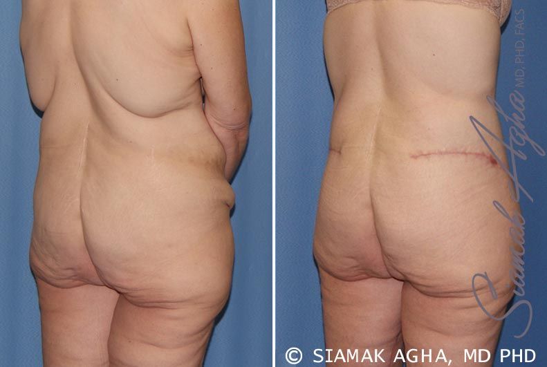Tummy Tuck Before & After