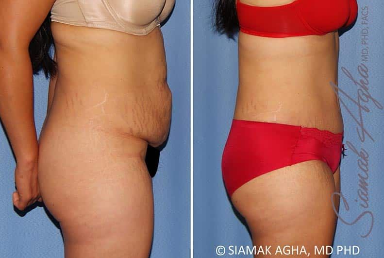 Tummy Tuck Before & After