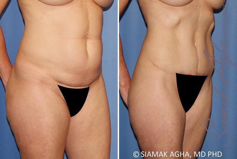 Tummy Tuck Before & After