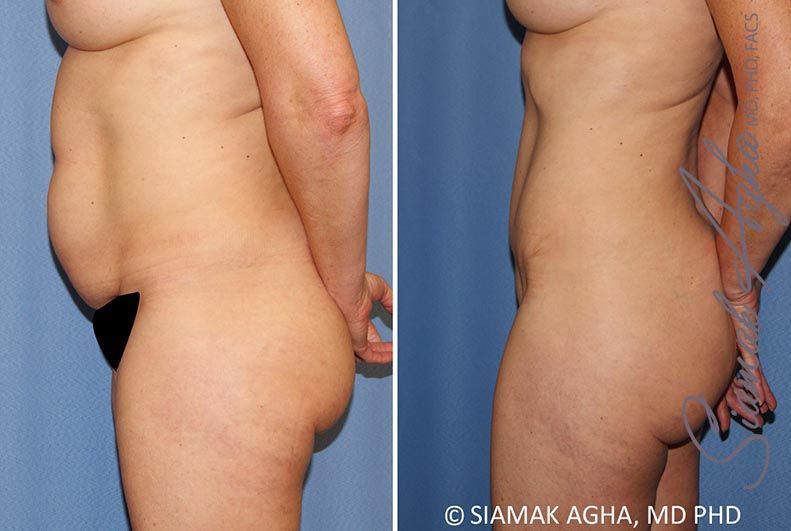 Tummy Tuck Before & After