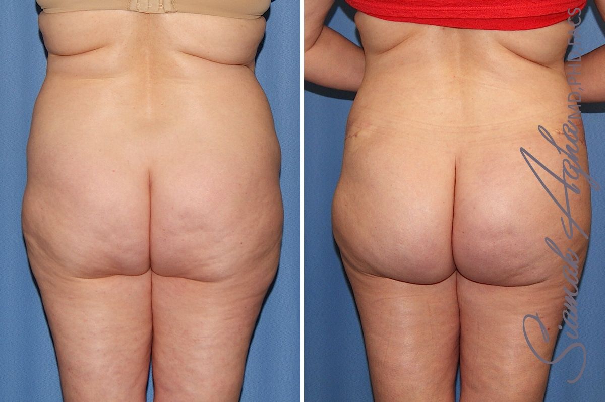 Tummy Tuck Before & After