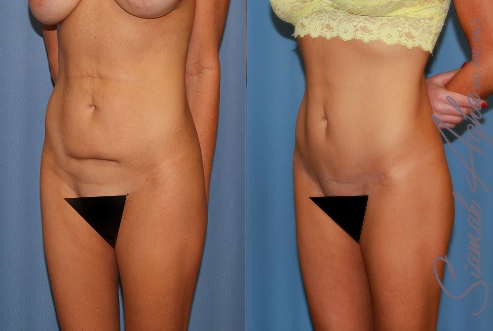Tummy Tuck Before & After