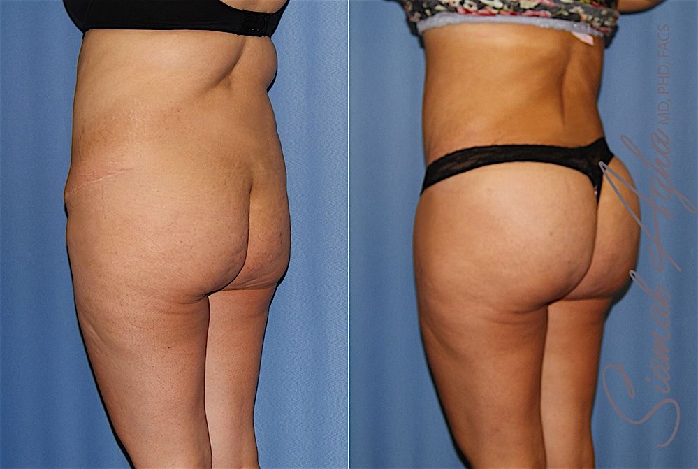 Tummy Tuck Before & After