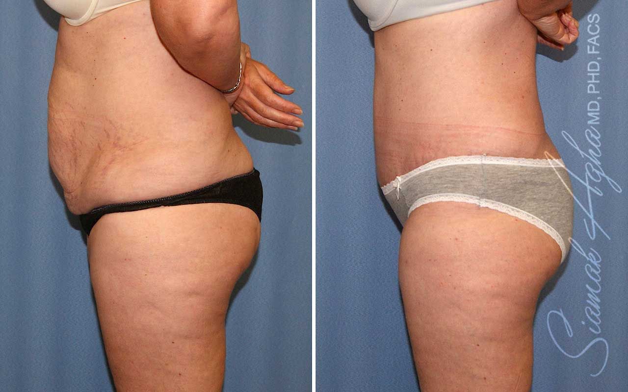 Tummy Tuck Before & After