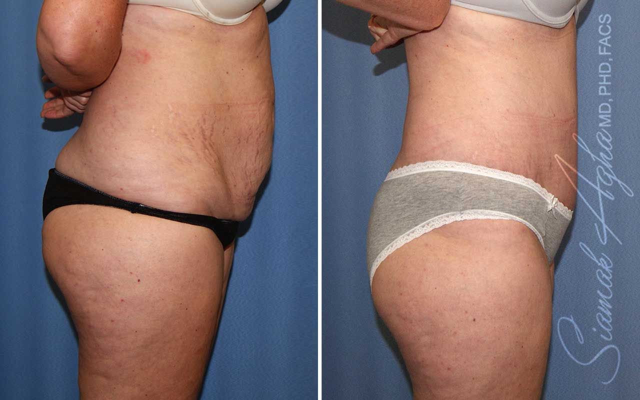 Tummy Tuck Before & After