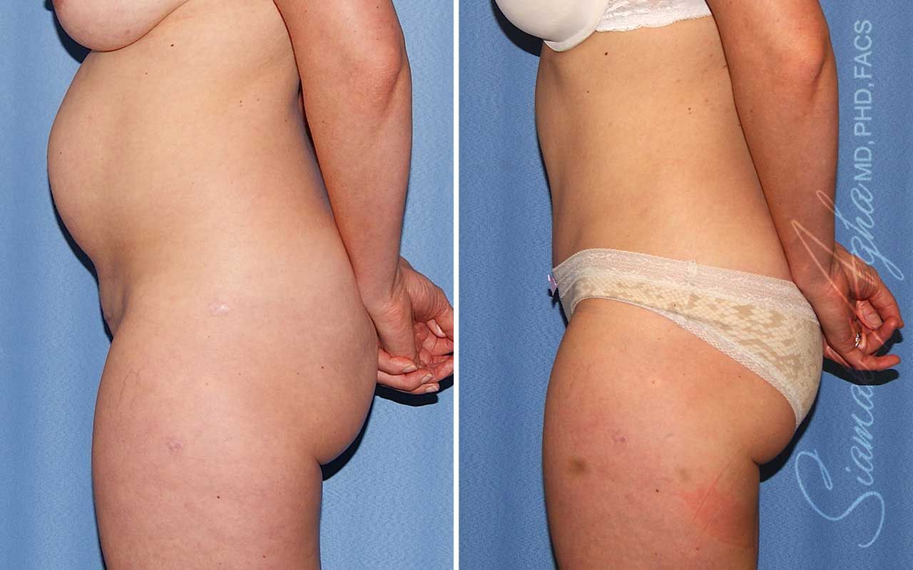 Tummy Tuck Before & After