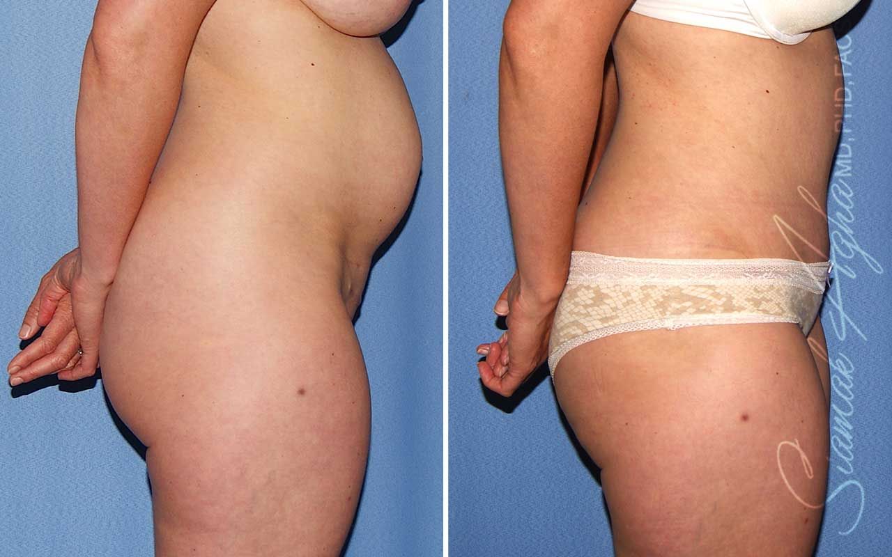 Tummy Tuck Before & After