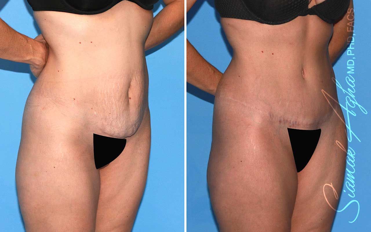 Tummy Tuck Before & After