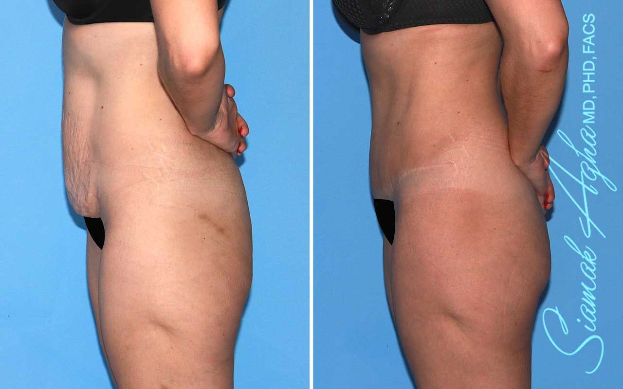Tummy Tuck Before & After